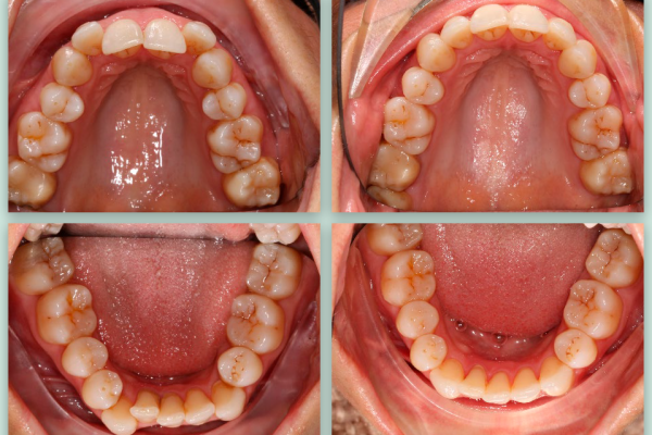 BEaligned Cases 2